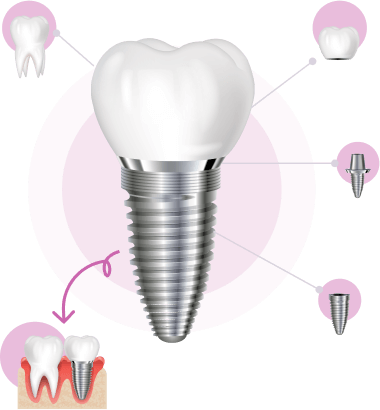 trong-rang-implant-la-gi