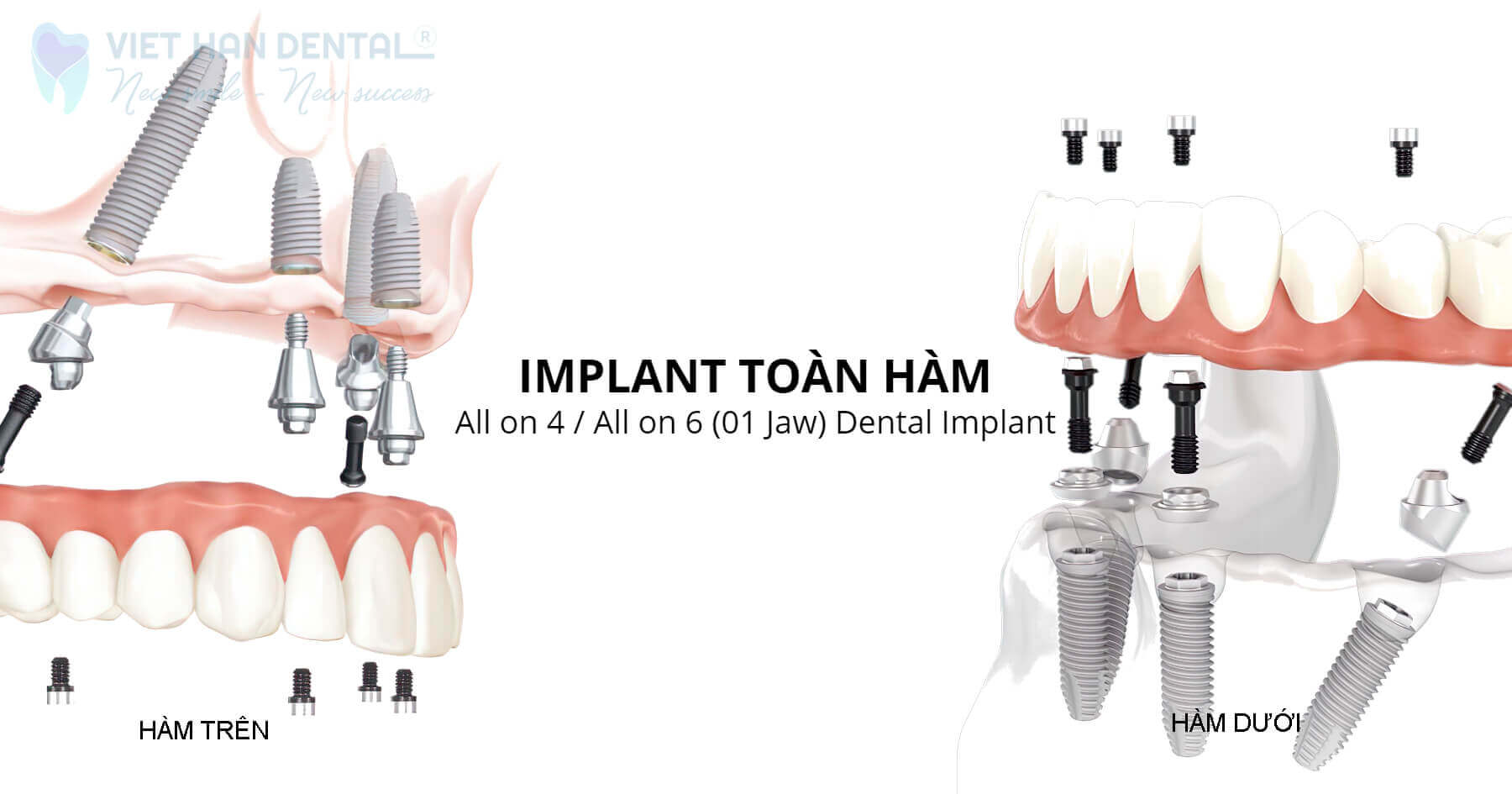 Trồng răng Implant toàn hàm